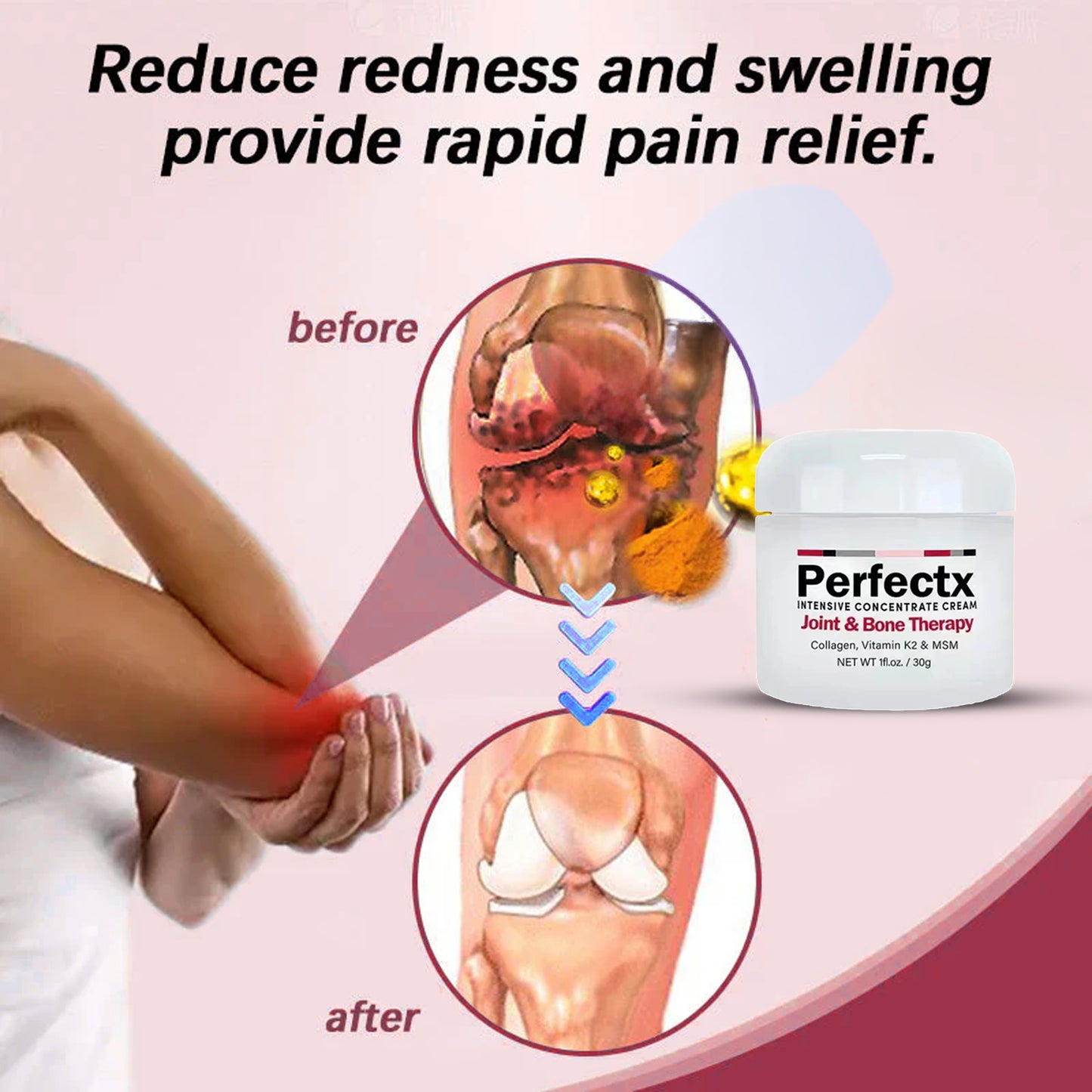 PerfectX™ – End Joint Pain Without Surgery